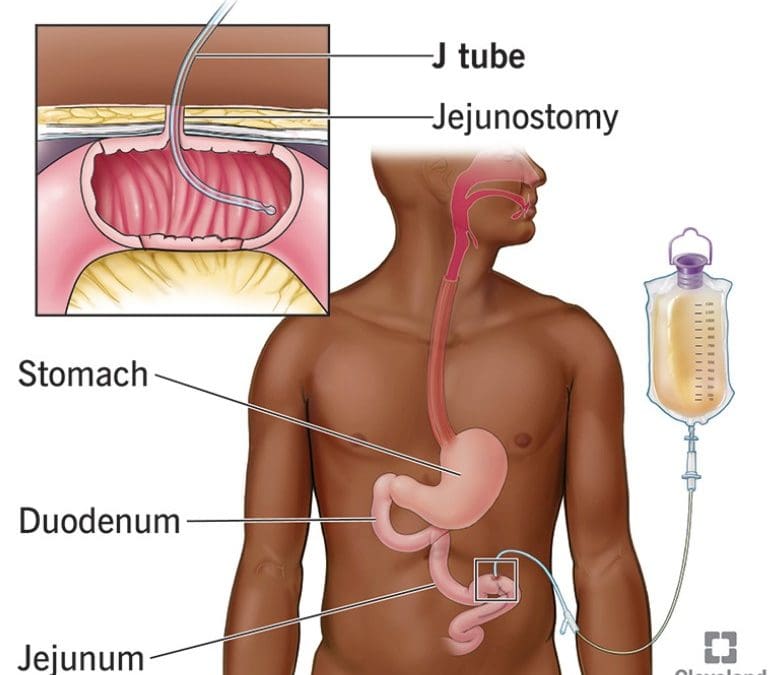 Rehabilitation After Feeding Tube Placement
