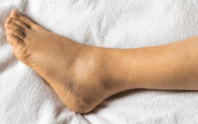 How Long Does a Sprained Ankle Take to Heal?