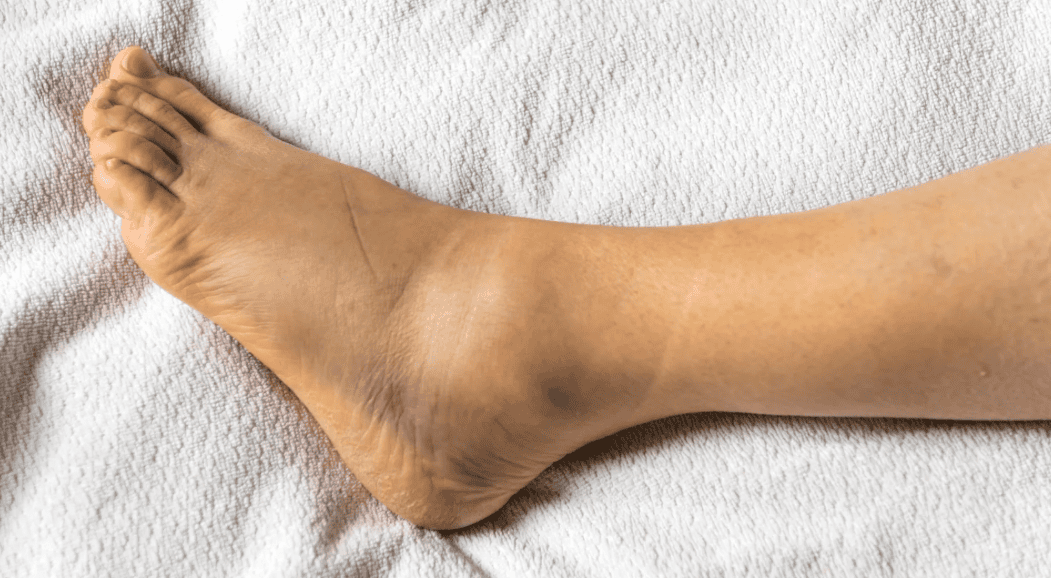 How Long Does a Sprained Ankle Take to Heal?